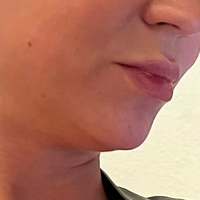 misslobatox Nøgen